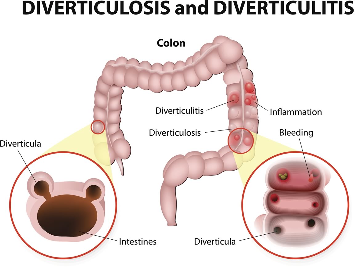 Diverticulitis – Digestive Disease Associates, LTD. – Hinsdale